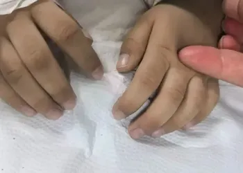 3岁男孩长期吃隔夜剩饭剩菜中毒，四肢都发青了家长没当回事，教师坚持送医救了一命
New