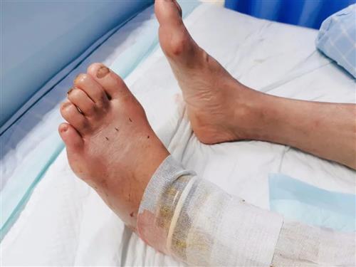 给孙子冲奶粉，就被“偷袭”了一口！毒蛇频繁出没！泸州又有人被咬伤入院-8.jpg