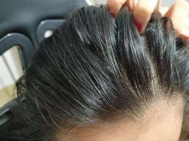 头油头痒，竟然需要去医院做检查？头上长了这种虫卵要当心-2.jpg