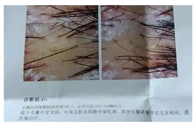 头油头痒，竟然需要去医院做检查？头上长了这种虫卵要当心-1.jpg