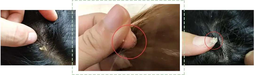 头油头痒，竟然需要去医院做检查？头上长了这种虫卵要当心-4.jpg