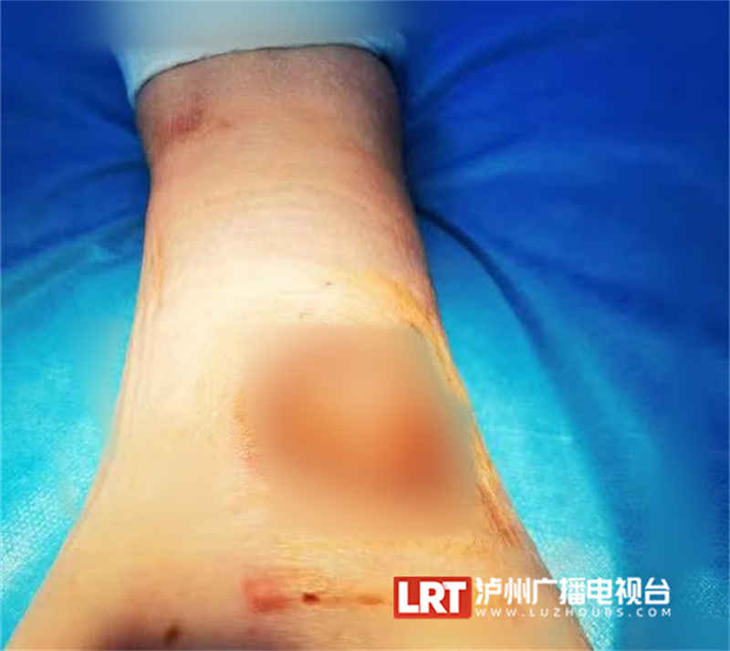 泸州：女子被烫出水泡，两周后皮肤坏死！冬季，小心低温烫伤！-3.jpg
